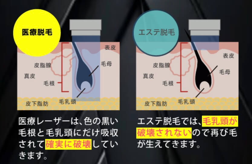 医療脱毛orエステ脱毛？ アルファクリニックメンズ医療脱毛