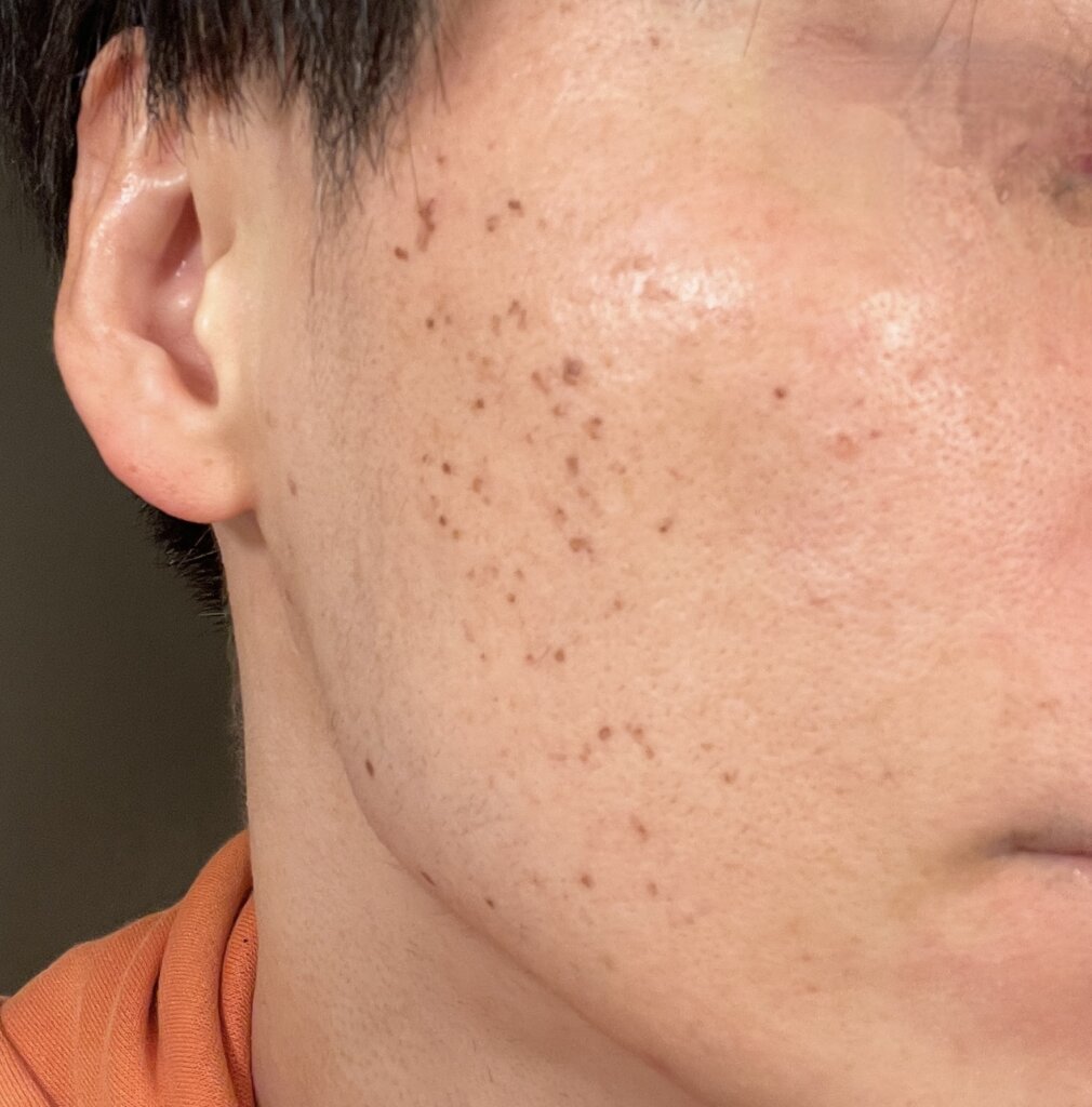 ダウンタイム|シミ取りレーザー施術後1週間の状態