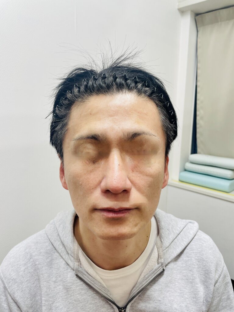 46歳男性(わたし自身)が 湘南美容クリニックで フォトトリプル5回セットを実際に体験
