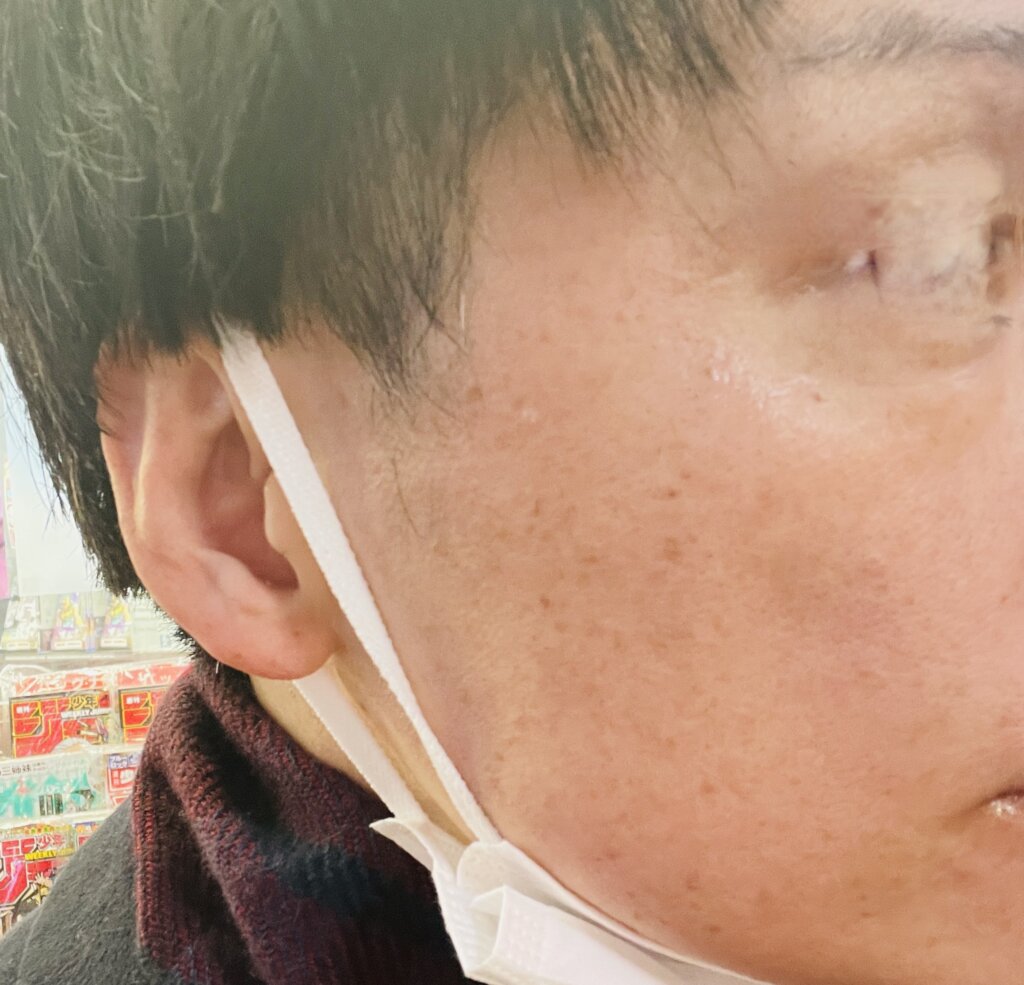 1回目直後|46歳男性が湘南美容クリニックでフォトトリプル5回セットを実際に体験。