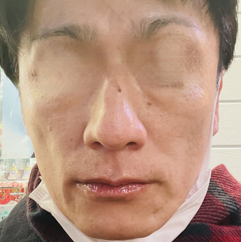 1回目施術直後|46歳男性(わたし自身)が 湘南美容クリニックで フォトトリプル5回セットを実際に体験