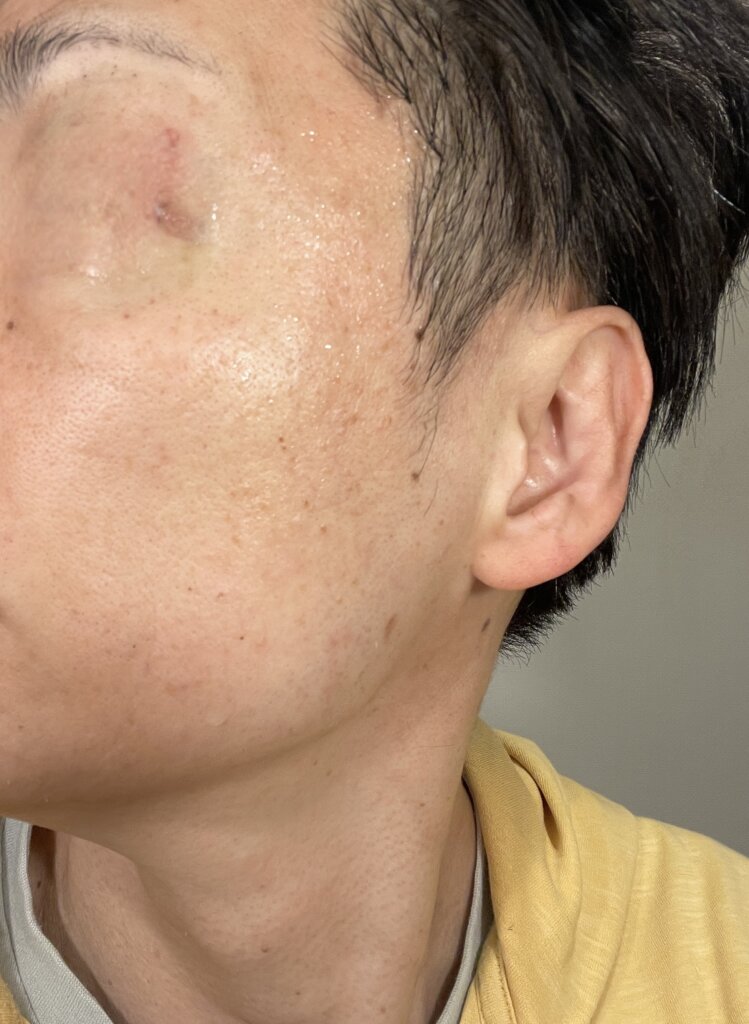 施術翌日の状態|フォトトリプル1回目