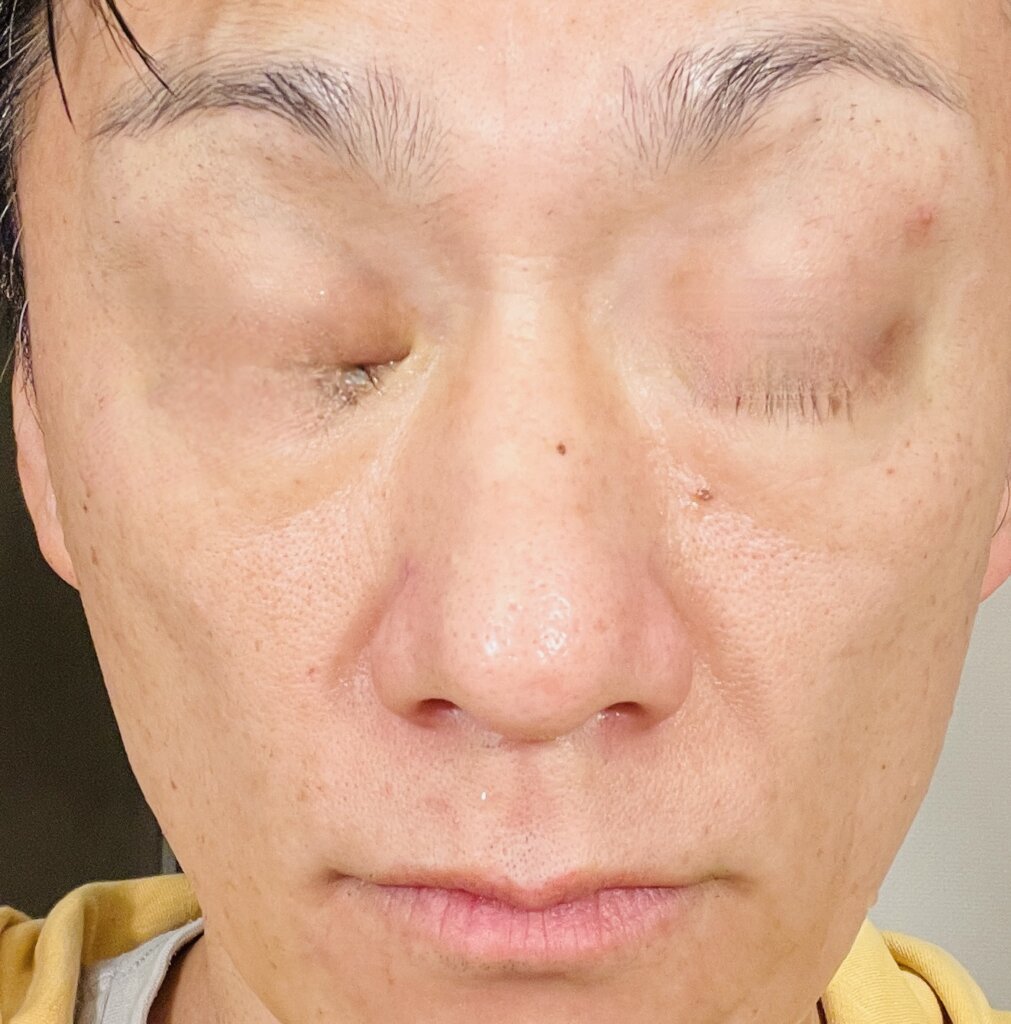 1回目施術後翌日|湘南美容クリニックフォトトリプル5回