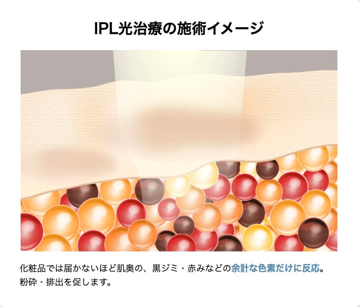 湘南美容クリニックのフォトトリプルとは?